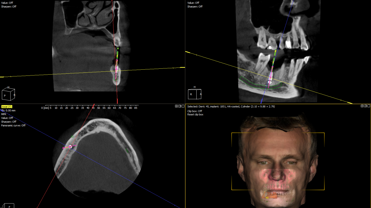 CBCT scan